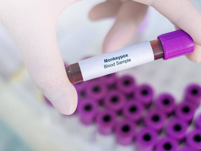Estados Unidos declara emergencia sanitaria por brote de casos de viruela del mono