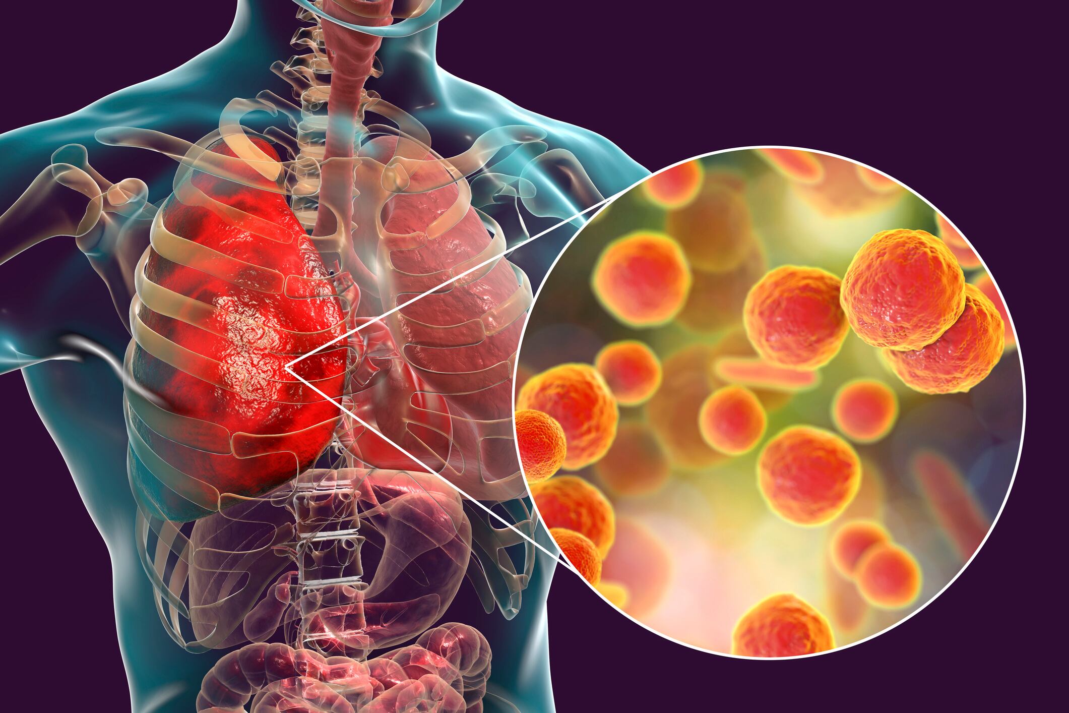 Neumonía por Mycoplasma | Getty Images