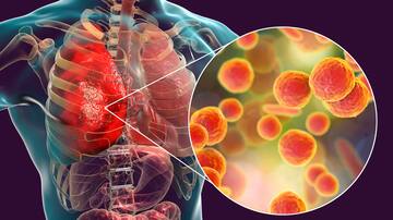 Neumonía por Mycoplasma en Chile: los síntomas de la peligrosa bacteria que podría ser mortal, según expertos