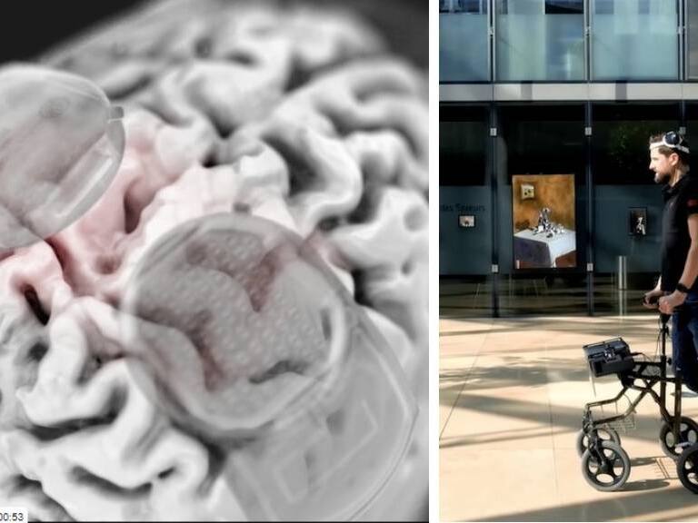 Increíble innovación médica: implante cerebral devuelve la capacidad de caminar a un hombre paralítico