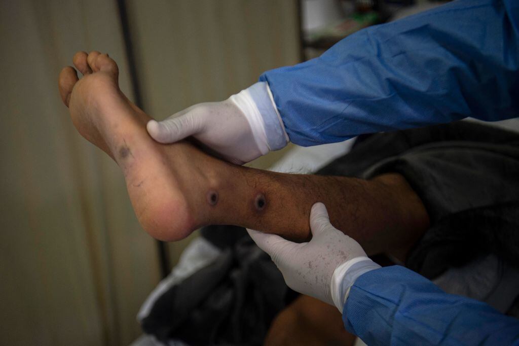 Médico revisa las lesiones que deja la viruela del mono en un paciente