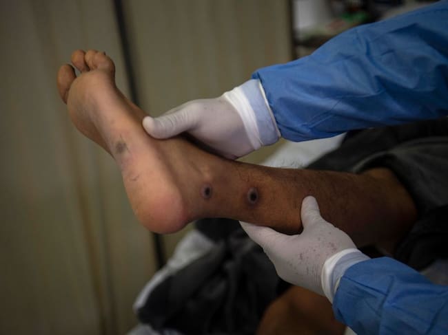 Médico revisa las lesiones que deja la viruela del mono en un paciente