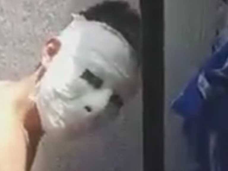 Accidentada tarea: estudiante hizo una máscara de yeso y se le pegó en su cara