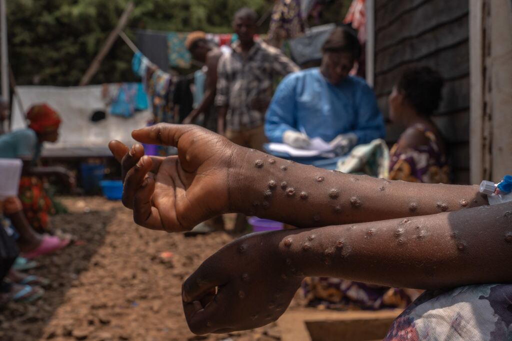 En las afueras del Hospital Kavumu en la República Democrática del Congo una persona muestra las heridas que provoca la viruela del mono.