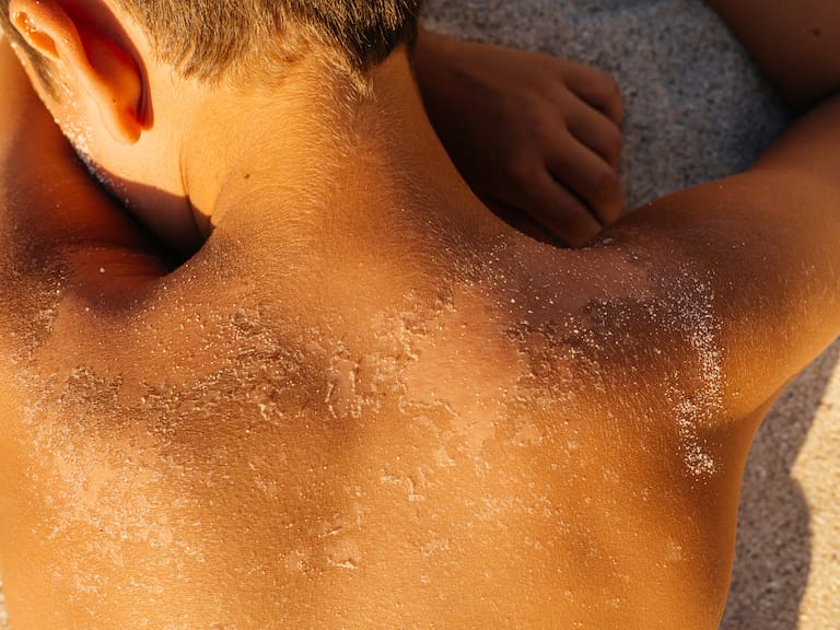 Verano sin quemaduras: consejos clave de COANIQUEM para proteger a niños y adolescentes