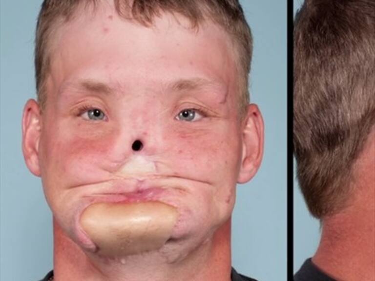 Realizan exitoso trasplante de rostro en joven que intentó suicidarse