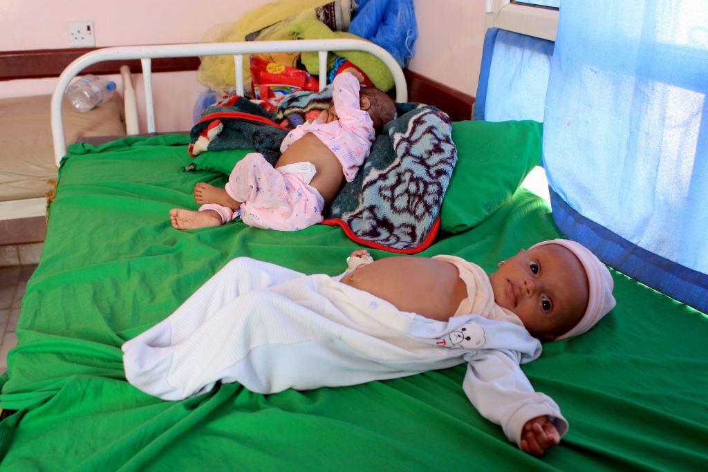 Niños reciben asistencia médica por desnutrición por el hambre en Yemen