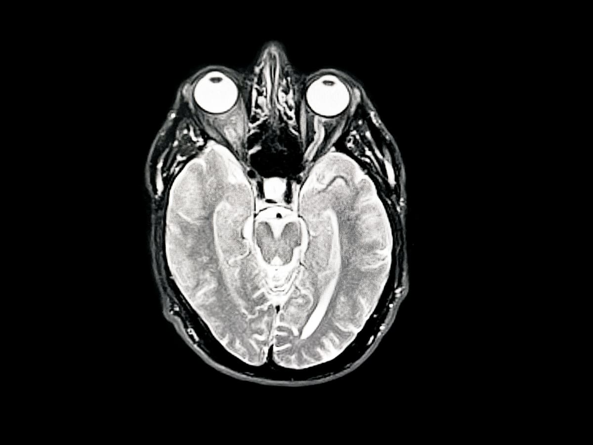 Entrenamiento cerebral enfocado en la velocidad mental podría retrasar el Alzheimer, según estudio de dos décadas