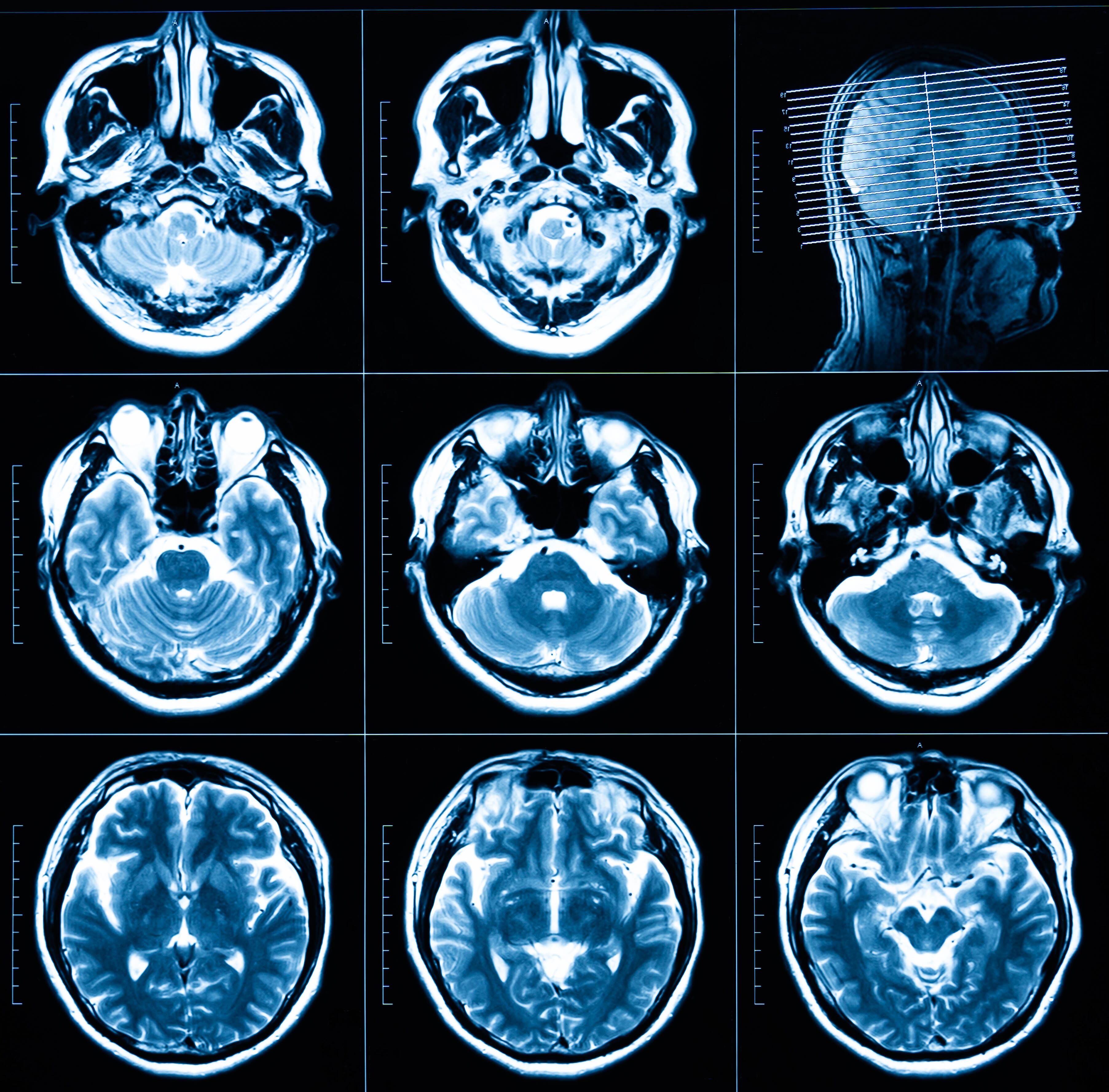 Escáner a cerebro / Getty Images referencial