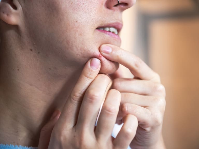 Lo llaman “el triángulo de la muerte”: la peligrosa zona en que no se debe reventar nunca una espinilla, según experto