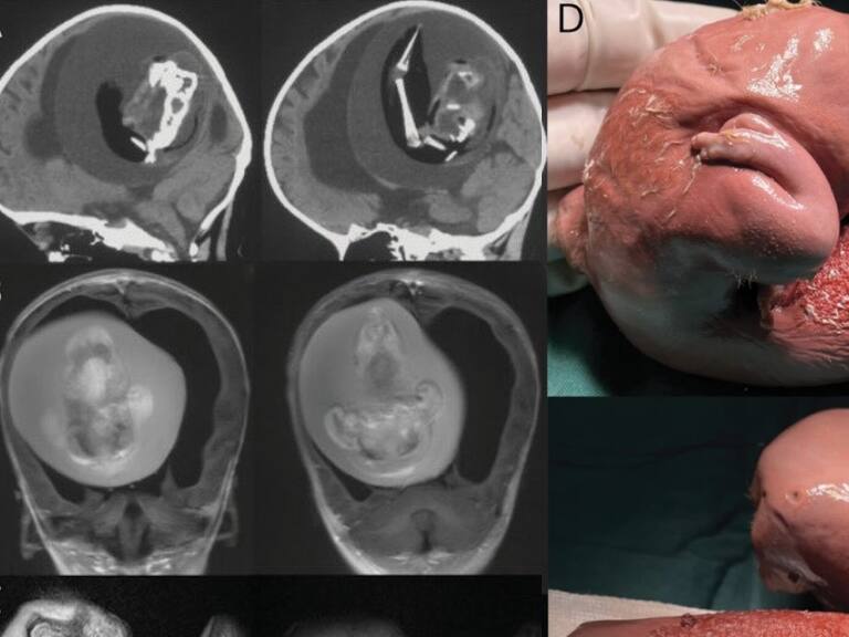 Extraen del cerebro de una niña a su «gemelo parásito»