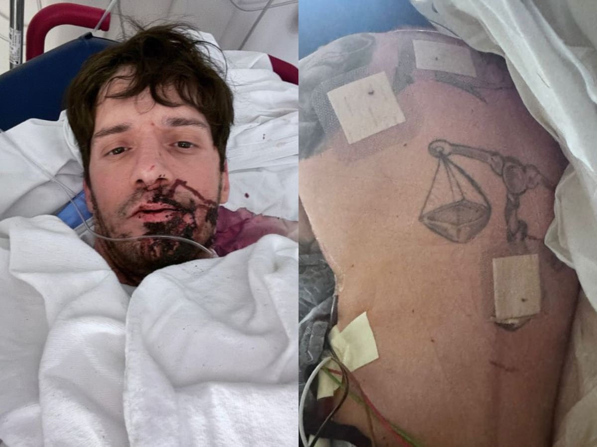 Apuñalado y con un pulmón colapsado: creador de contenido para adultos sufre brutal ataque