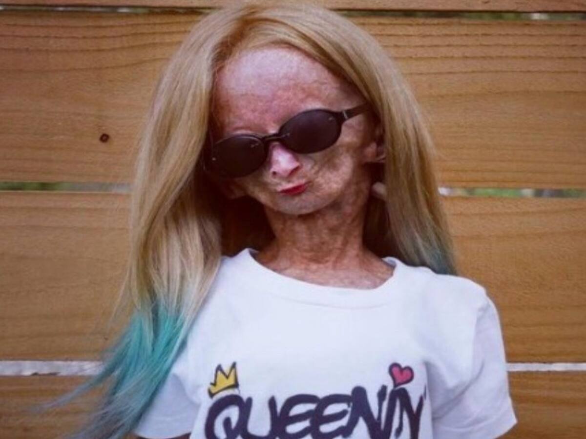 Falleció Adalia Rose, la joven youtuber que inspiró la película de Benjamin Button