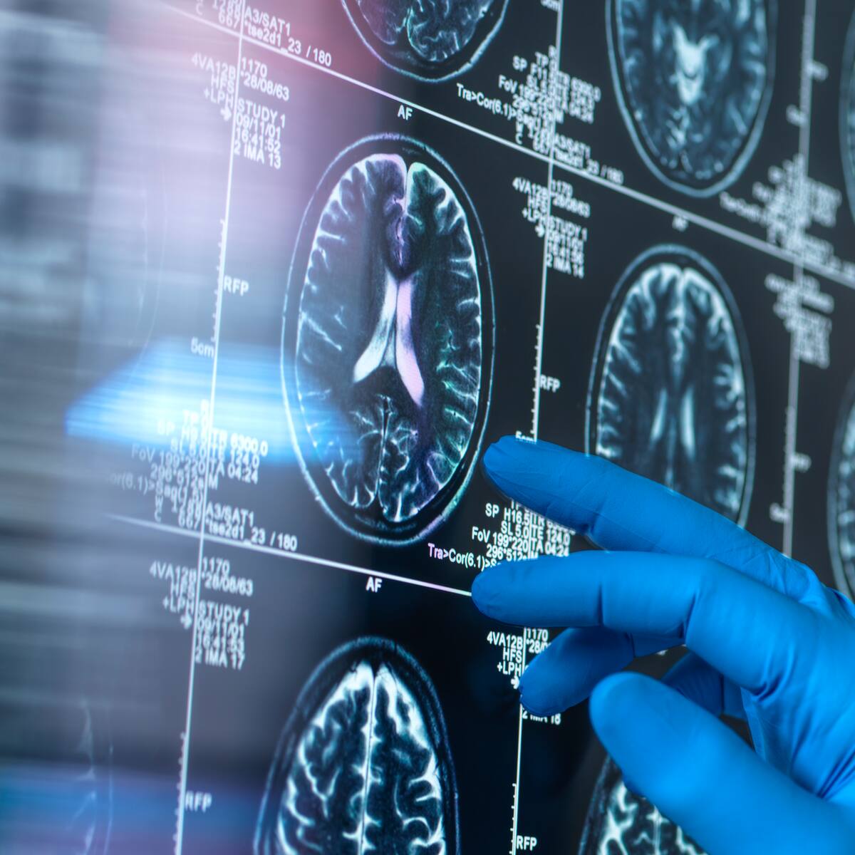 Este nutriente es esencial para nutrir el cerebro y se encuentra en estos alimentos