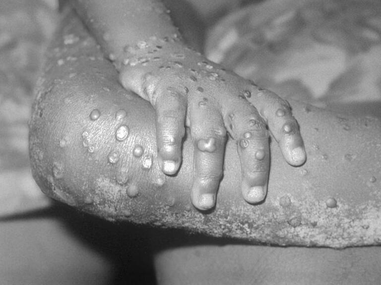 Viruela del mono: Gobierno de Uruguay confirma cuatro casos sospechosos