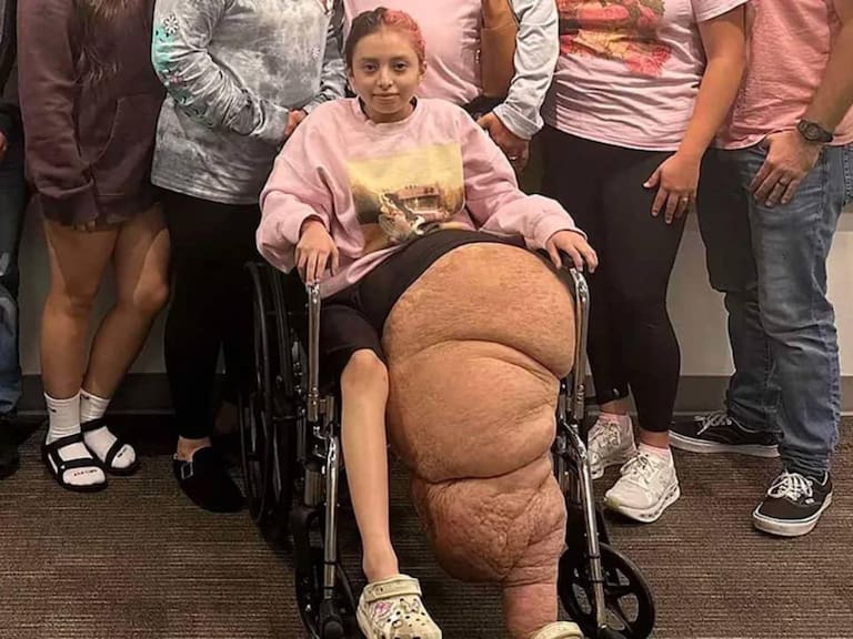 Joven de 14 años se operó para amputar su pierna y quitar un tumor de casi 80 kilos: el antes y el después