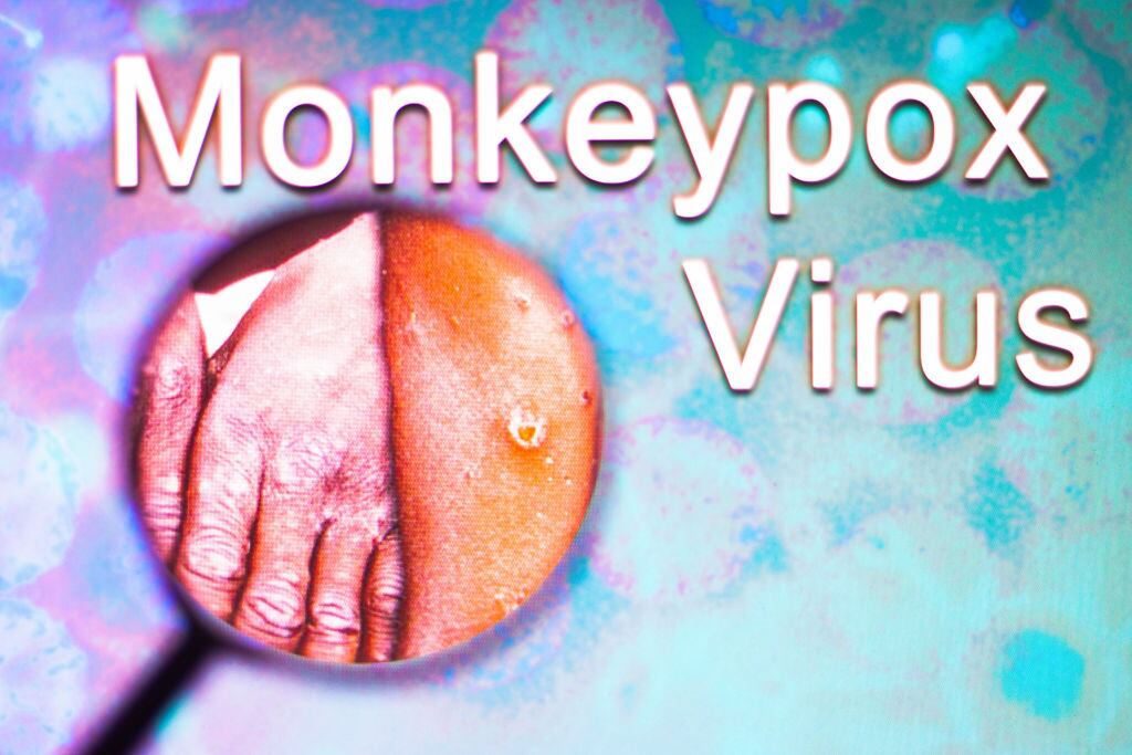 Imagen ilustrativa del virus de la viruela del mono