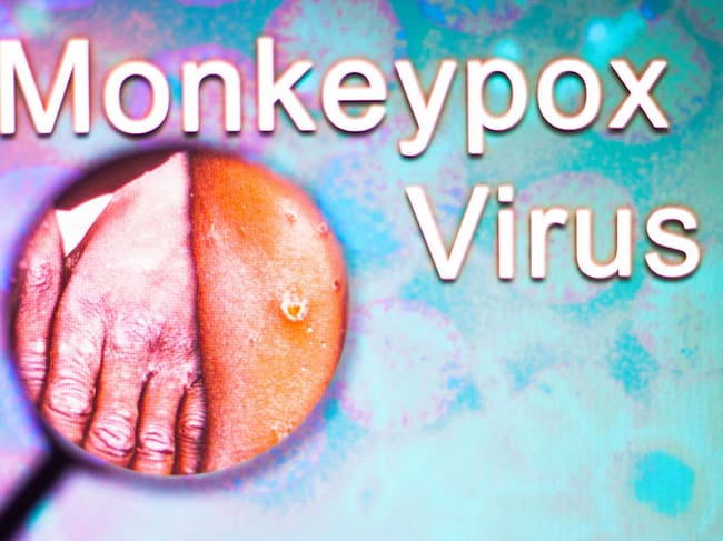 Imagen ilustrativa del virus de la viruela del mono