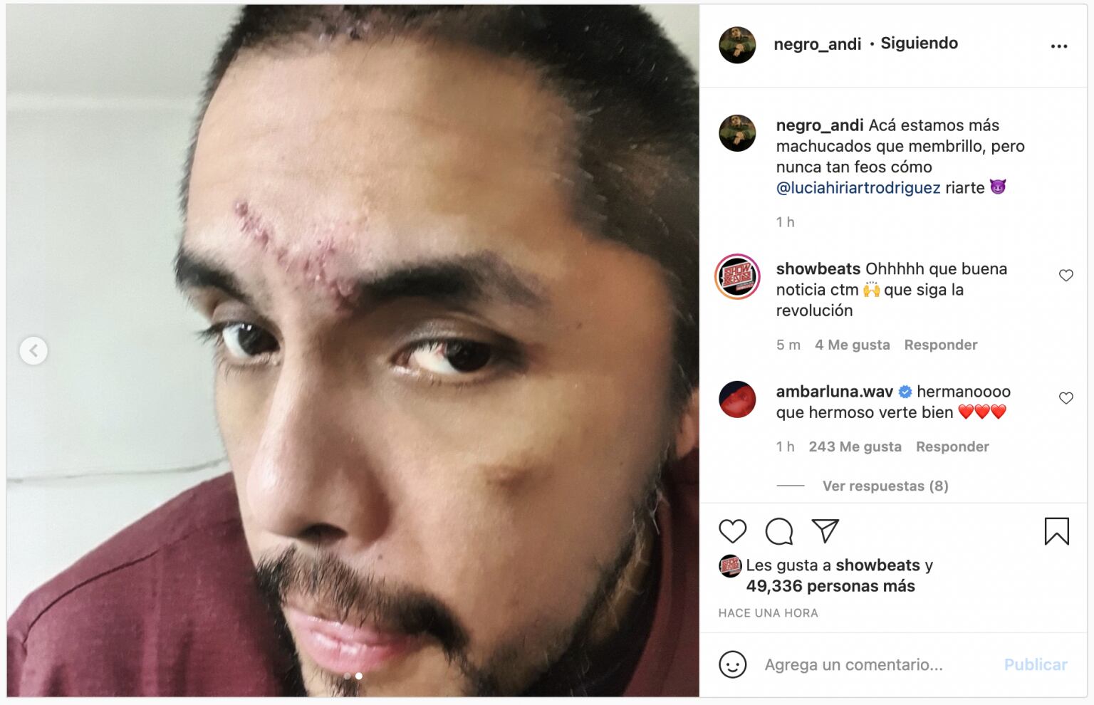 Portavoz reaparece tras su accidente con provocativa frase: Subió fotos de su rostro y luego las borró | Captura Instagram