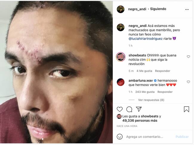 Portavoz reaparece tras su accidente con provocativa frase: Subió fotos de su rostro y luego las borró | Captura Instagram
