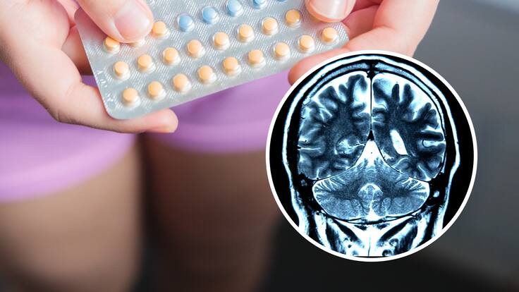¿Pueden los anticonceptivos alterar tu cerebro? Científica descubre sorprendentes cambios por consumo de pastillas orales