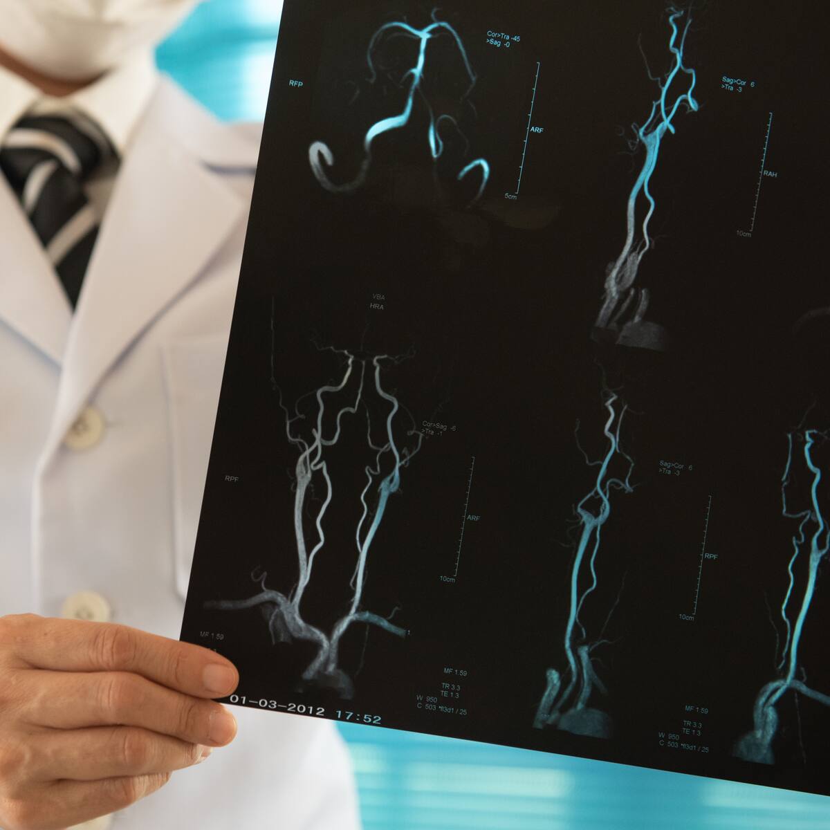 El método que logró reducir las secuelas tras un ACV y ahorrar millones al sistema de salud, según estudio