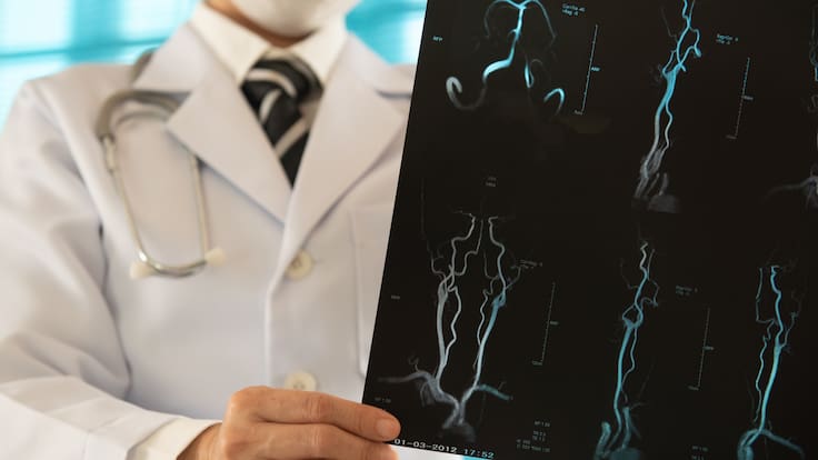 El método que logró reducir las secuelas tras un ACV y ahorrar millones al sistema de salud, según estudio