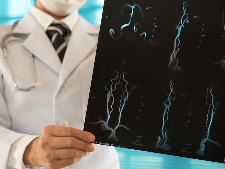 El método que logró reducir las secuelas tras un ACV y ahorrar millones al sistema de salud, según estudio