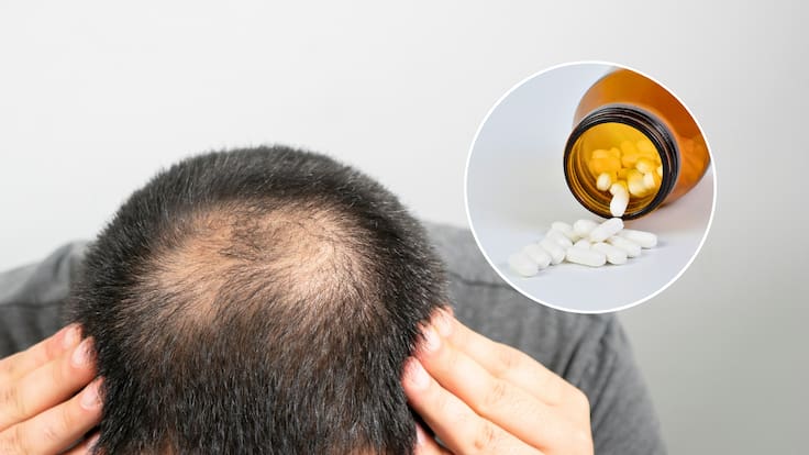 ISP alerta por fármaco contra la calvicie que provocaría depresión, ideación suicida y disfunción sexual
