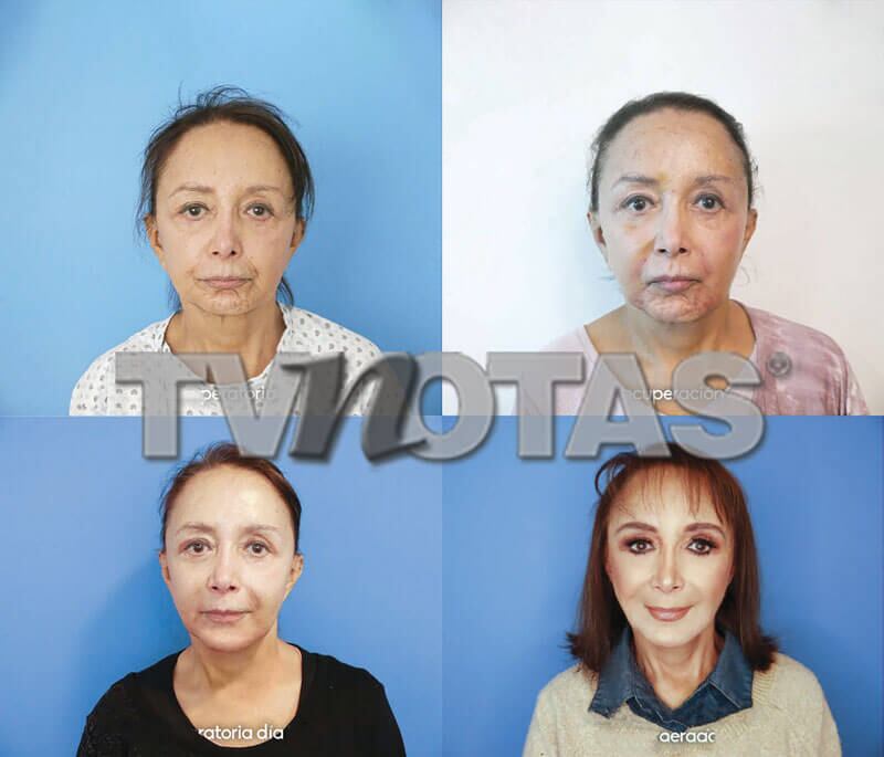 La Chilindrina y su cirugía en TV Notas