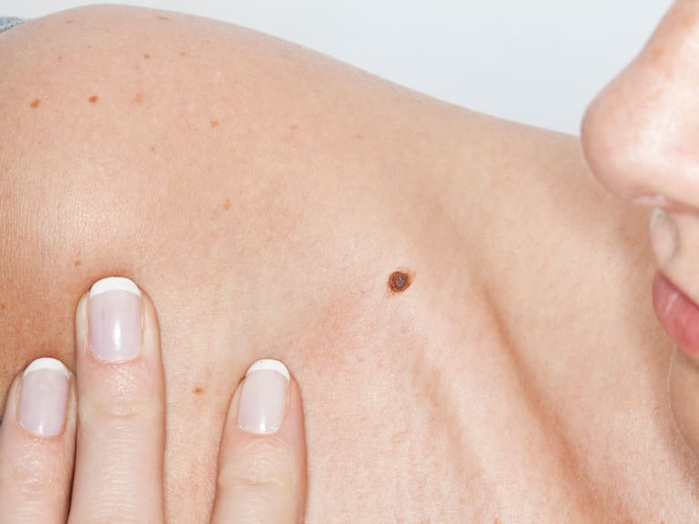 Más de 59 mil casos al año: los síntomas que muchos ignoran y que podrían alertar un cáncer a tiempo