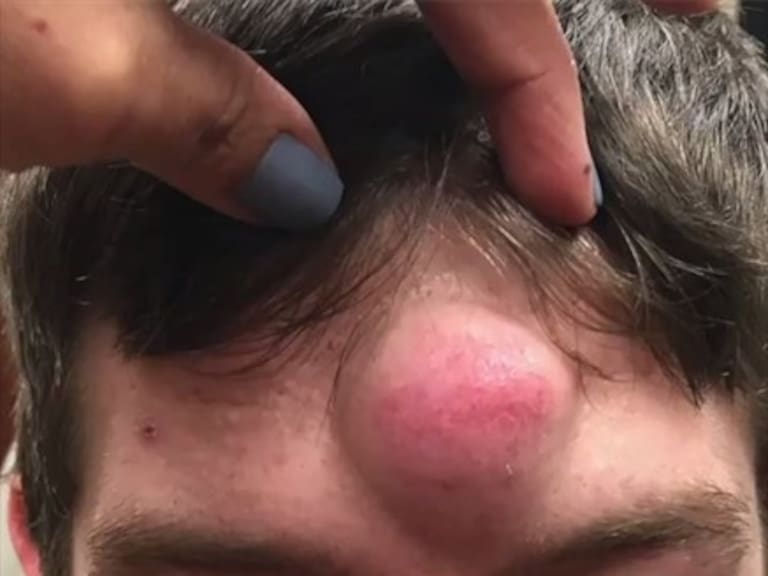 Difunden asquerosa cirugía para eliminar una espinilla gigante de la frente