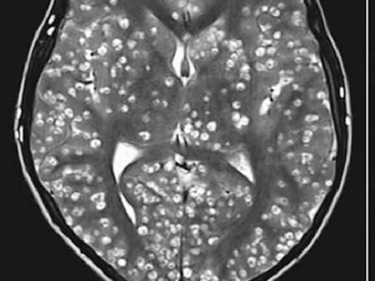 La enfermedad que llena de larvas el cerebro de las personas más pobres