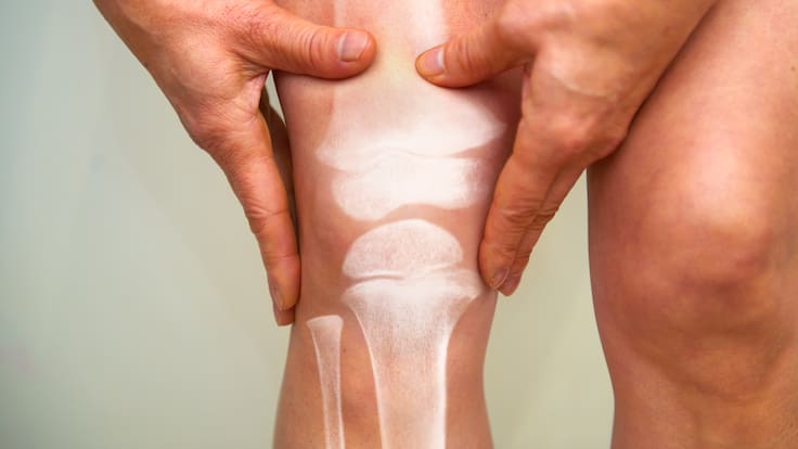 Artritis reumatoide: este hábito común puede empeorar esta enfermedad, según especialistas