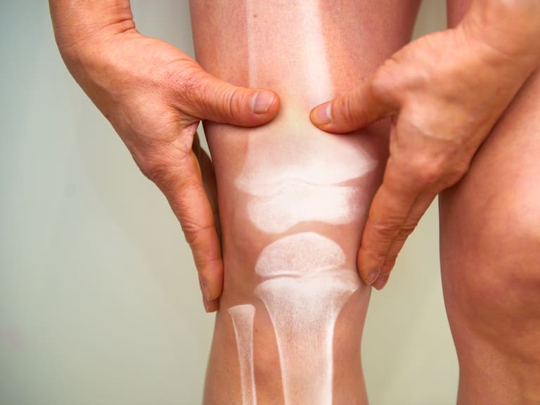 Artritis reumatoide: este hábito común puede empeorar esta enfermedad, según especialistas