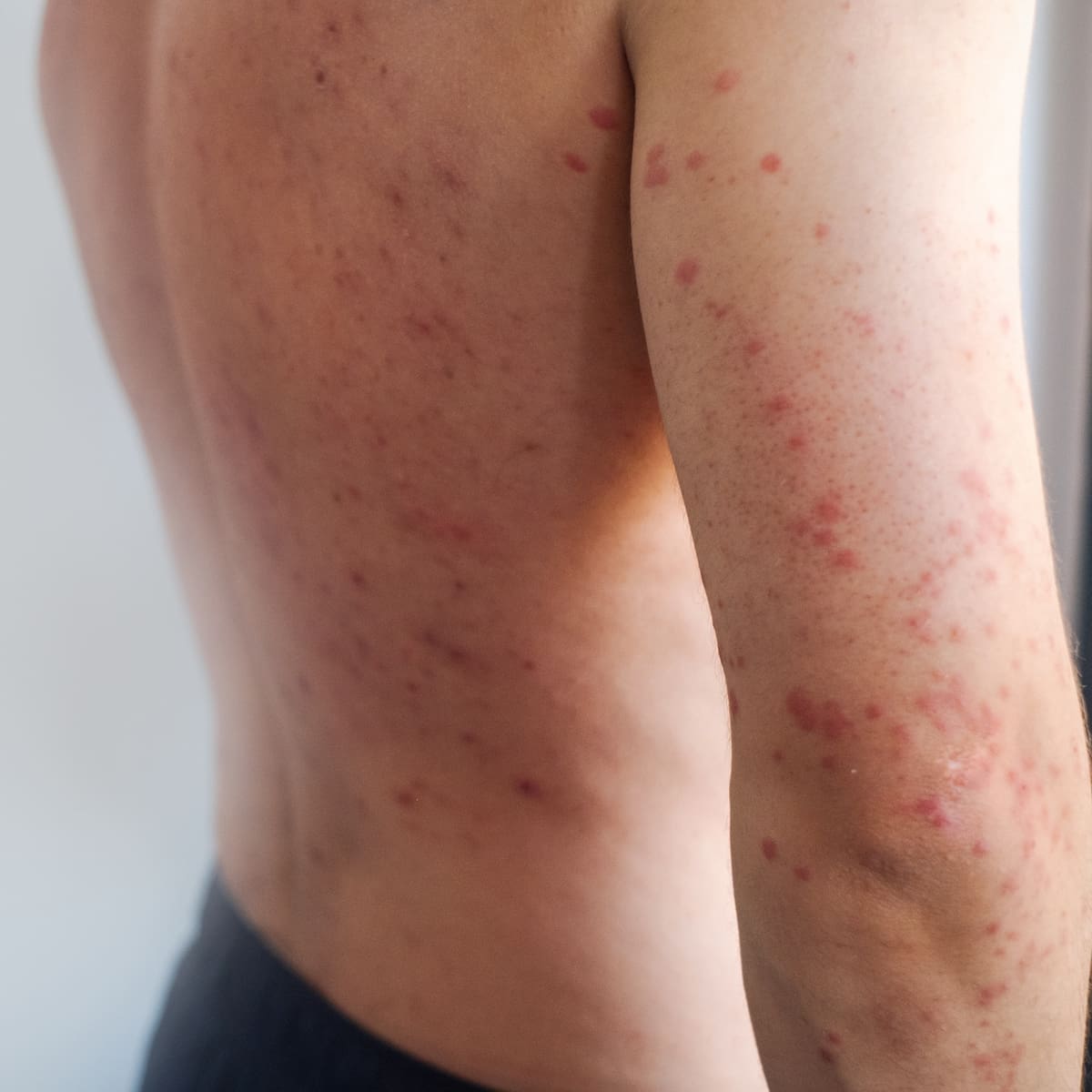 Minsal activa vigilancia epidemiológica tras detectarse nuevo caso de sarampión en Santiago