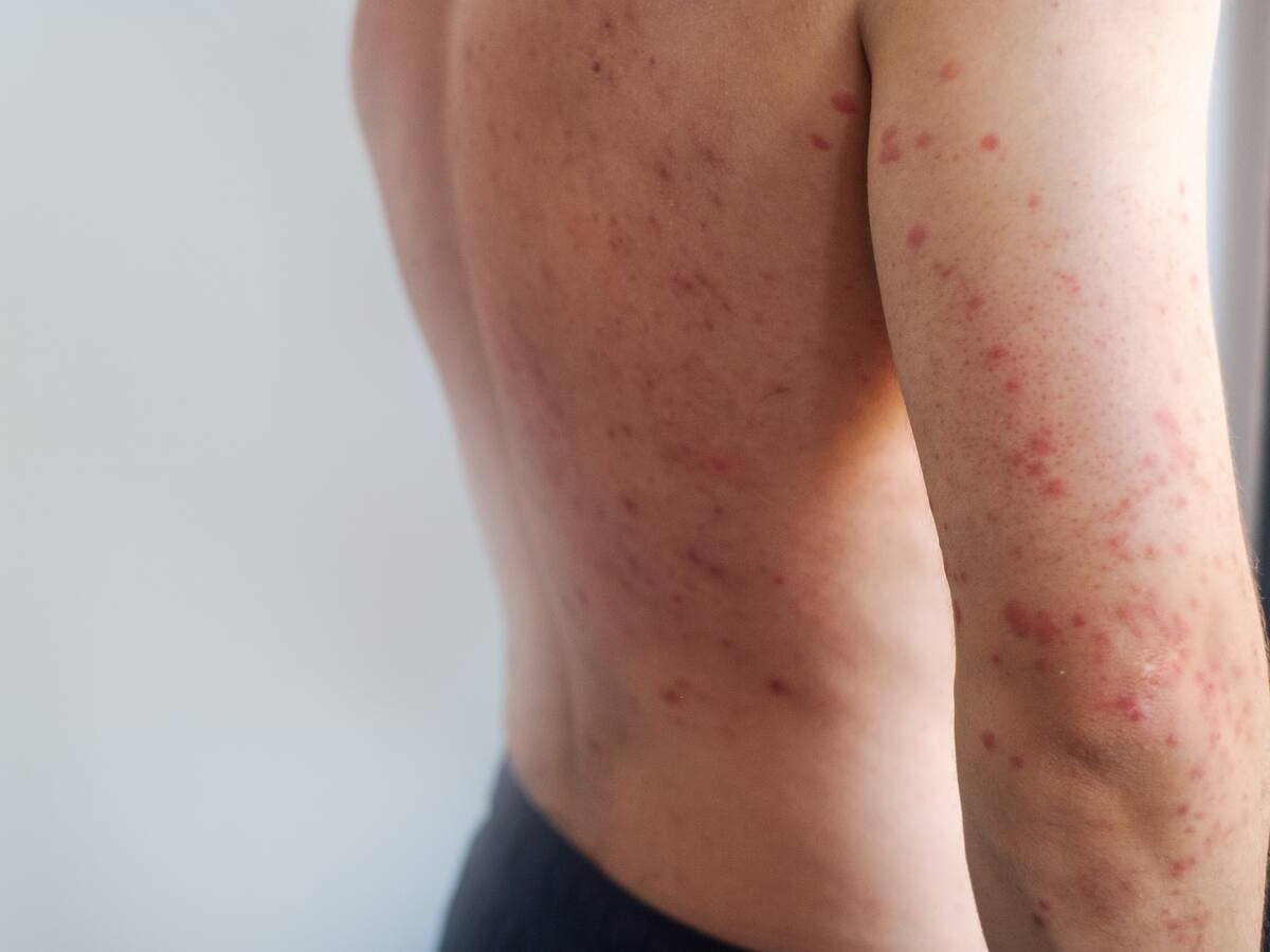 Minsal activa vigilancia epidemiológica tras detectarse nuevo caso de sarampión en Santiago