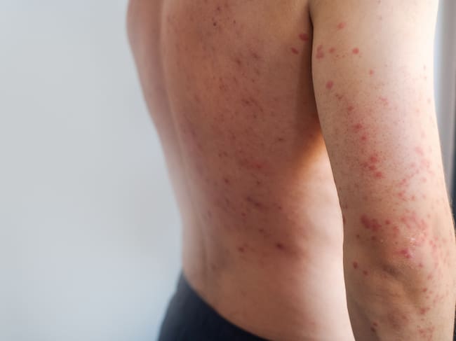 Minsal activa vigilancia epidemiológica por nuevo caso de sarampión.