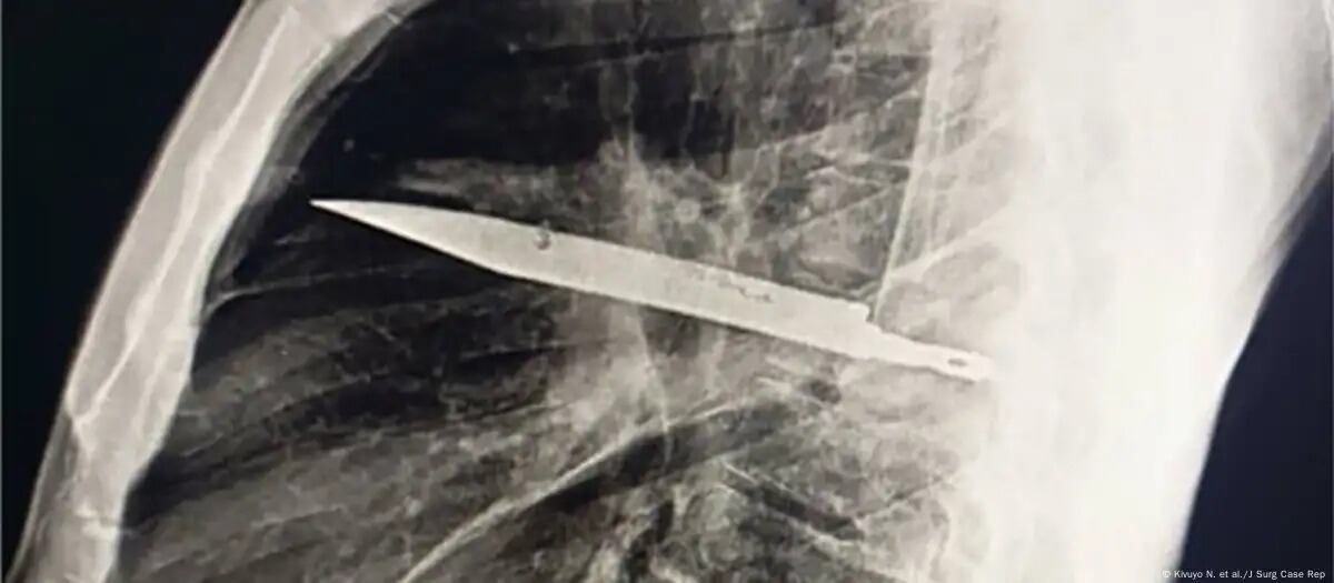 Imagen: Kivuyo N. et al./J Surg Case Rep