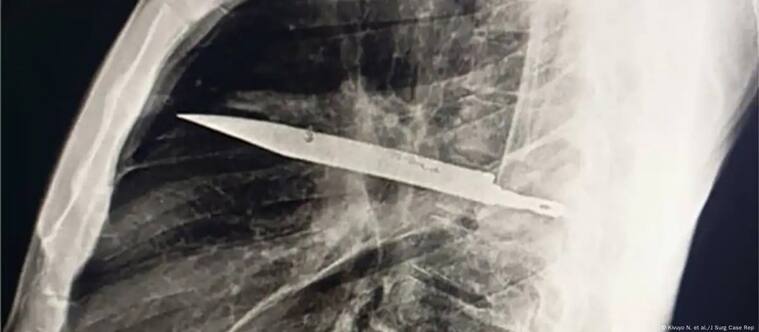 Imagen: Kivuyo N. et al./J Surg Case Rep