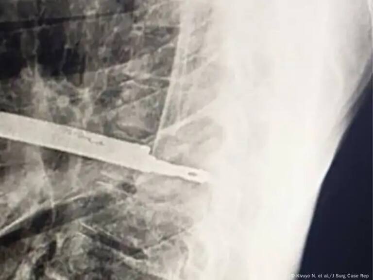 Imagen: Kivuyo N. et al./J Surg Case Rep