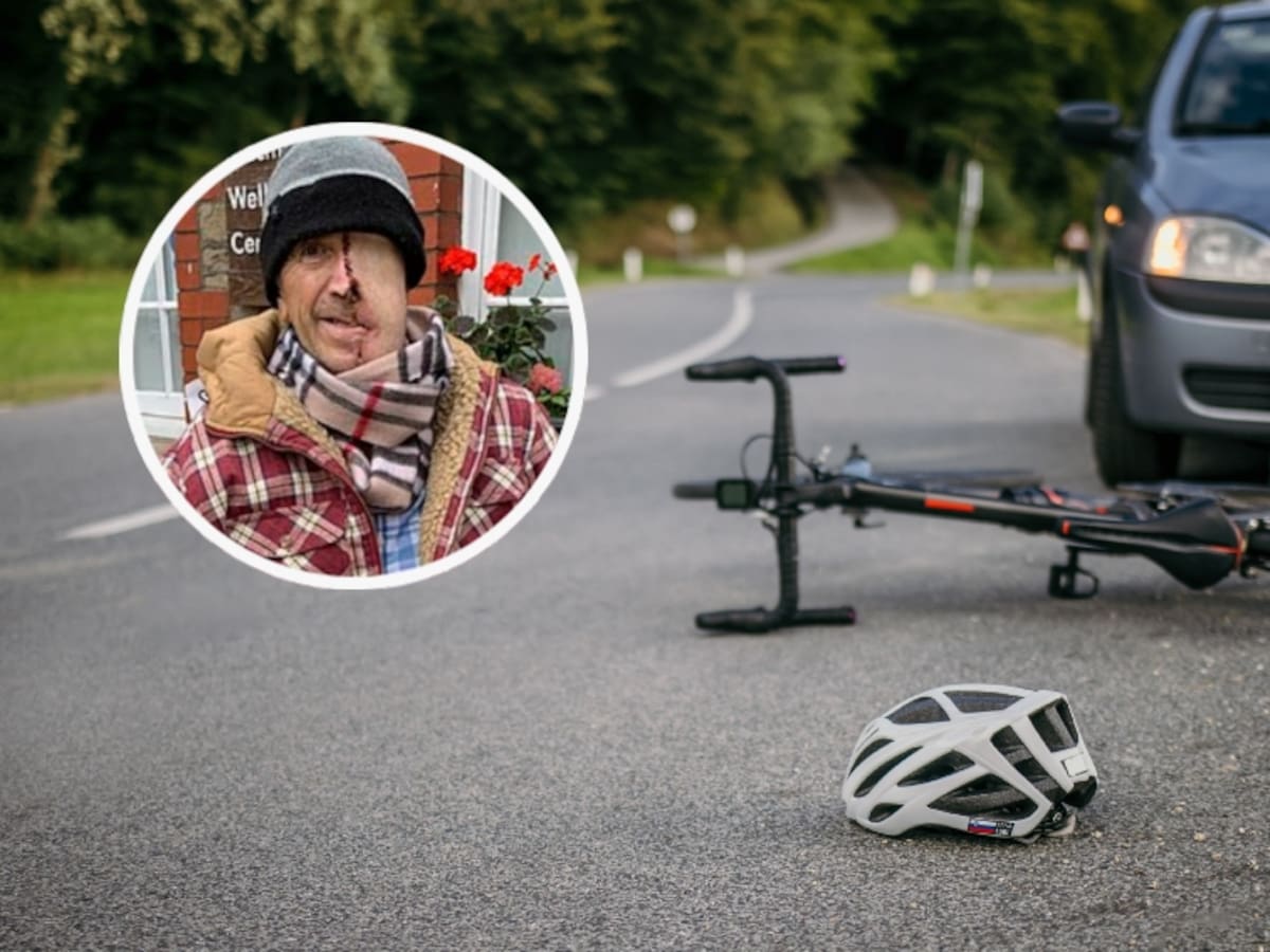 Ciclista de 75 años reconstruye su rostro con prótesis 3D tras brutal choque con conductor ebrio: así fue el resultado