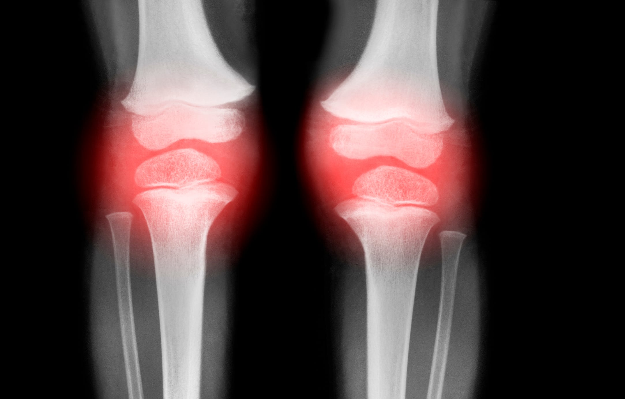 Artritis en rodillas 