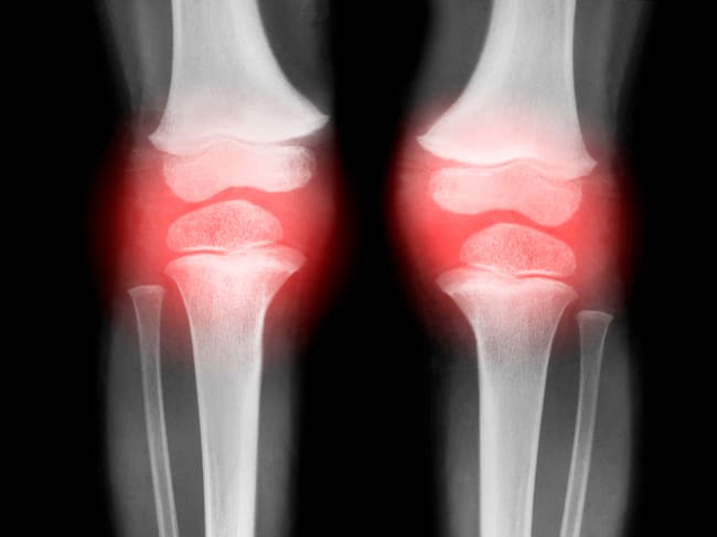 Artritis en rodillas