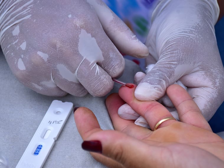 Contagio masivo de VIH