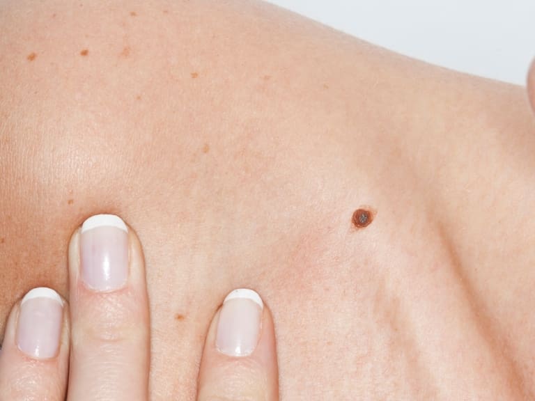 Los lunares peligrosos: cómo reconocerlos y tratarlos para evitar un posible cáncer a la piel