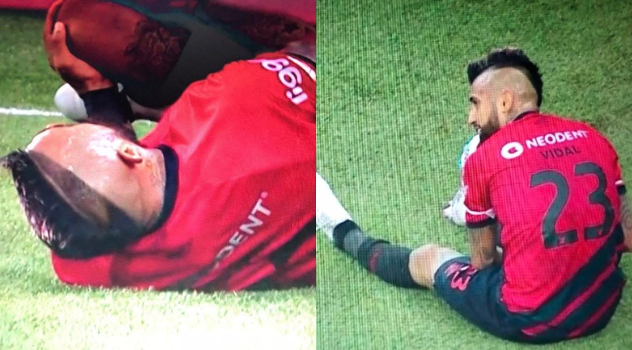 Arturo Vidal salió lesionado en duelo entre Athletico Paranaense y Fluminense por el Brasileirao