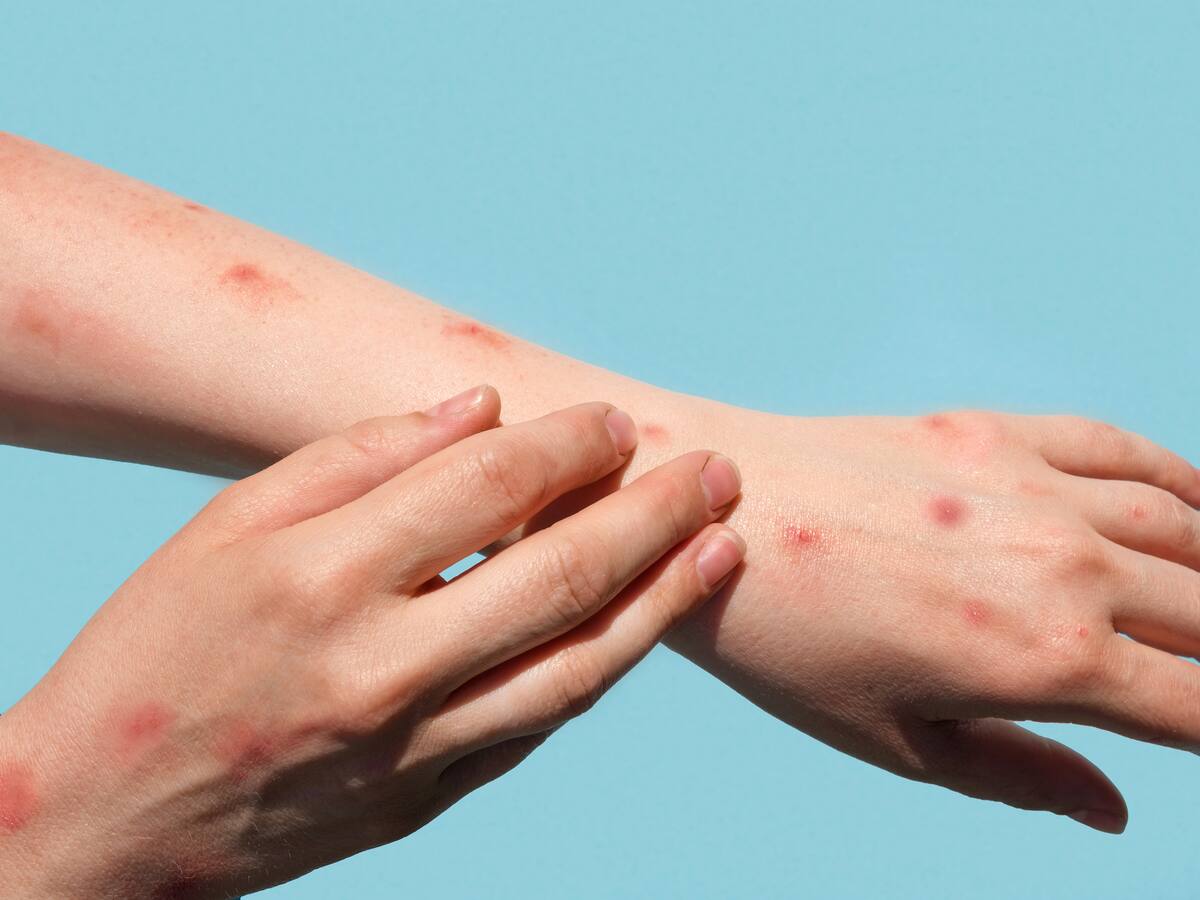 Tras advertencia de la OMS: Minsal declara alerta sanitaria por viruela del mono en Chile