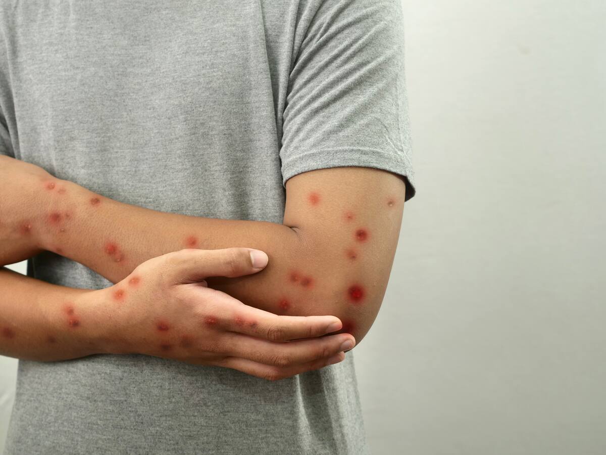 Estos son los primeros síntomas de la viruela del mono, cómo se contagia y quiénes se deberían vacunar en Chile