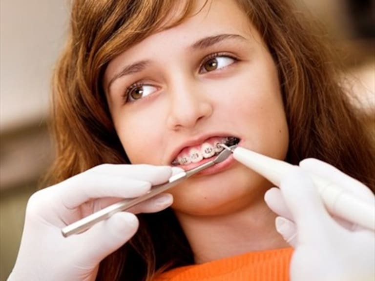 Técnica dental que acorta el uso de los frenillos llegó a Chile